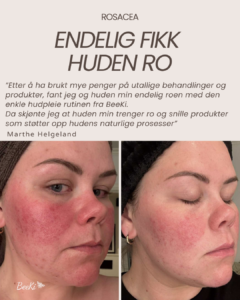 Marthe Rosacea 1