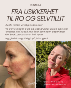 Stine Rosacea 1