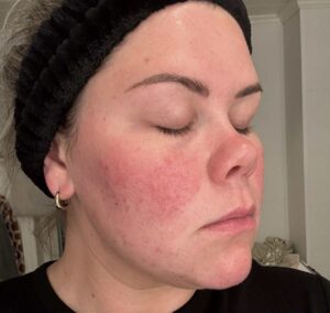 Marthe etter bruk av BeeKi